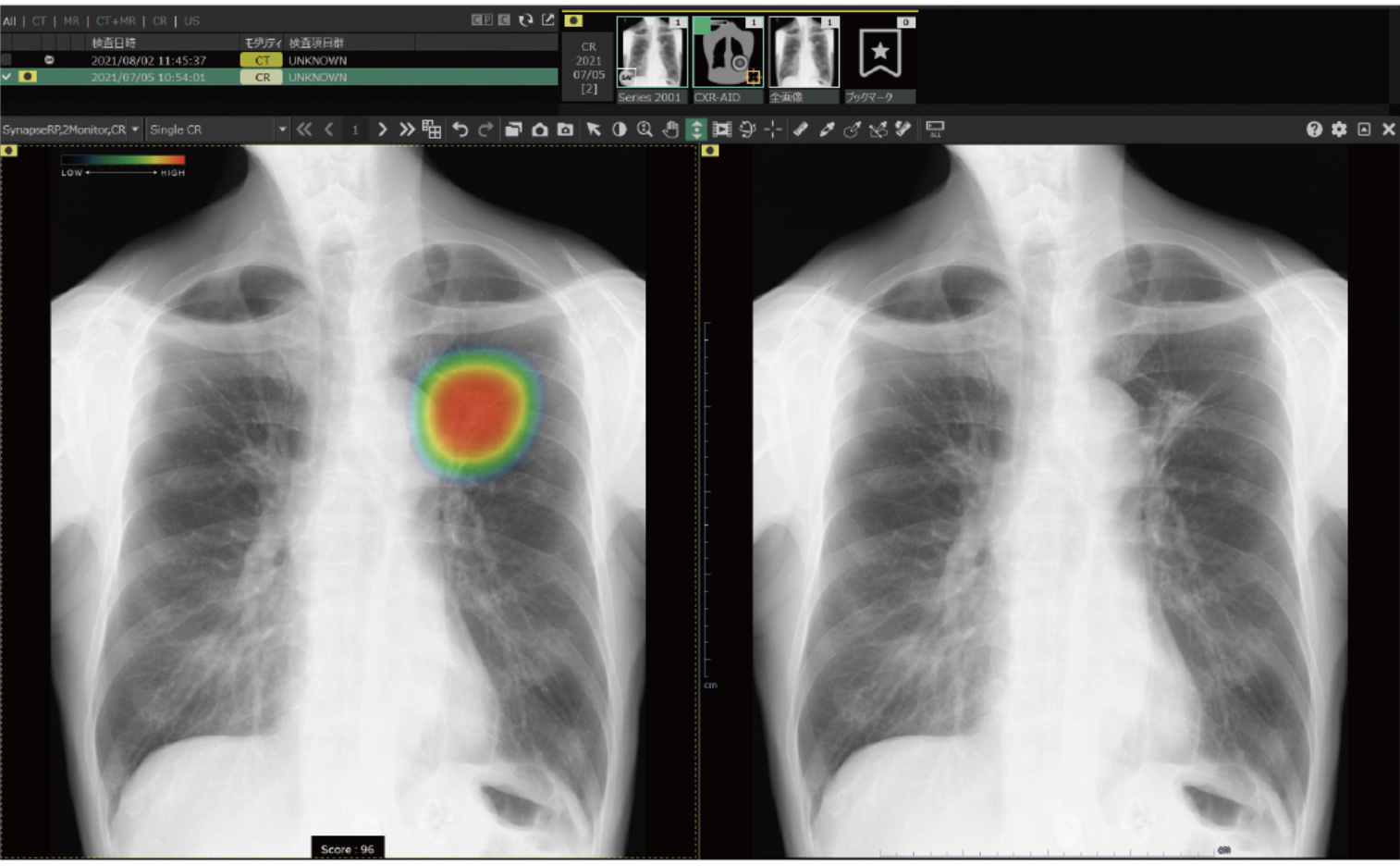 富士フイルム「胸部X線CADサービス」